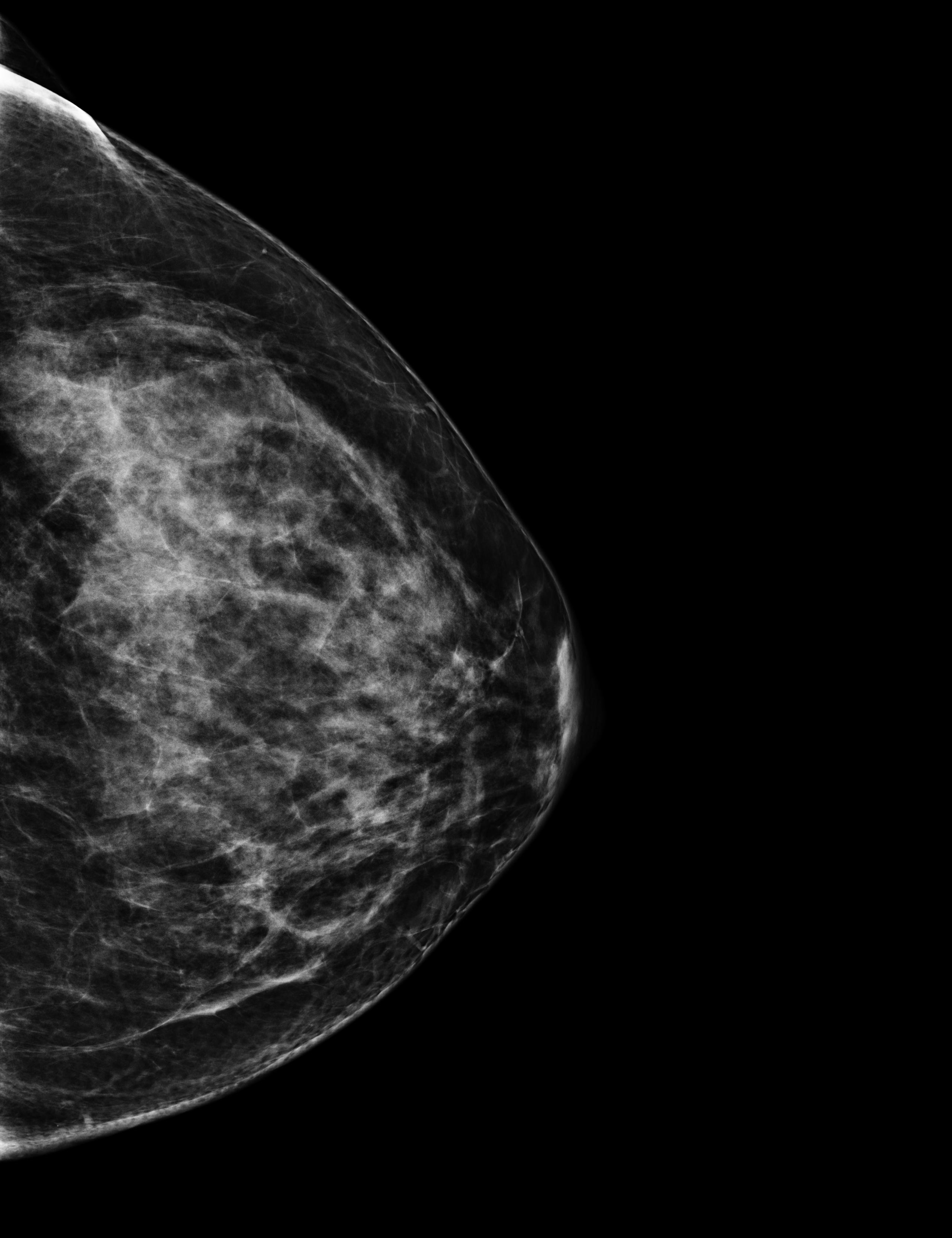 mammography, first visit with gynecologist: I was diagnosed