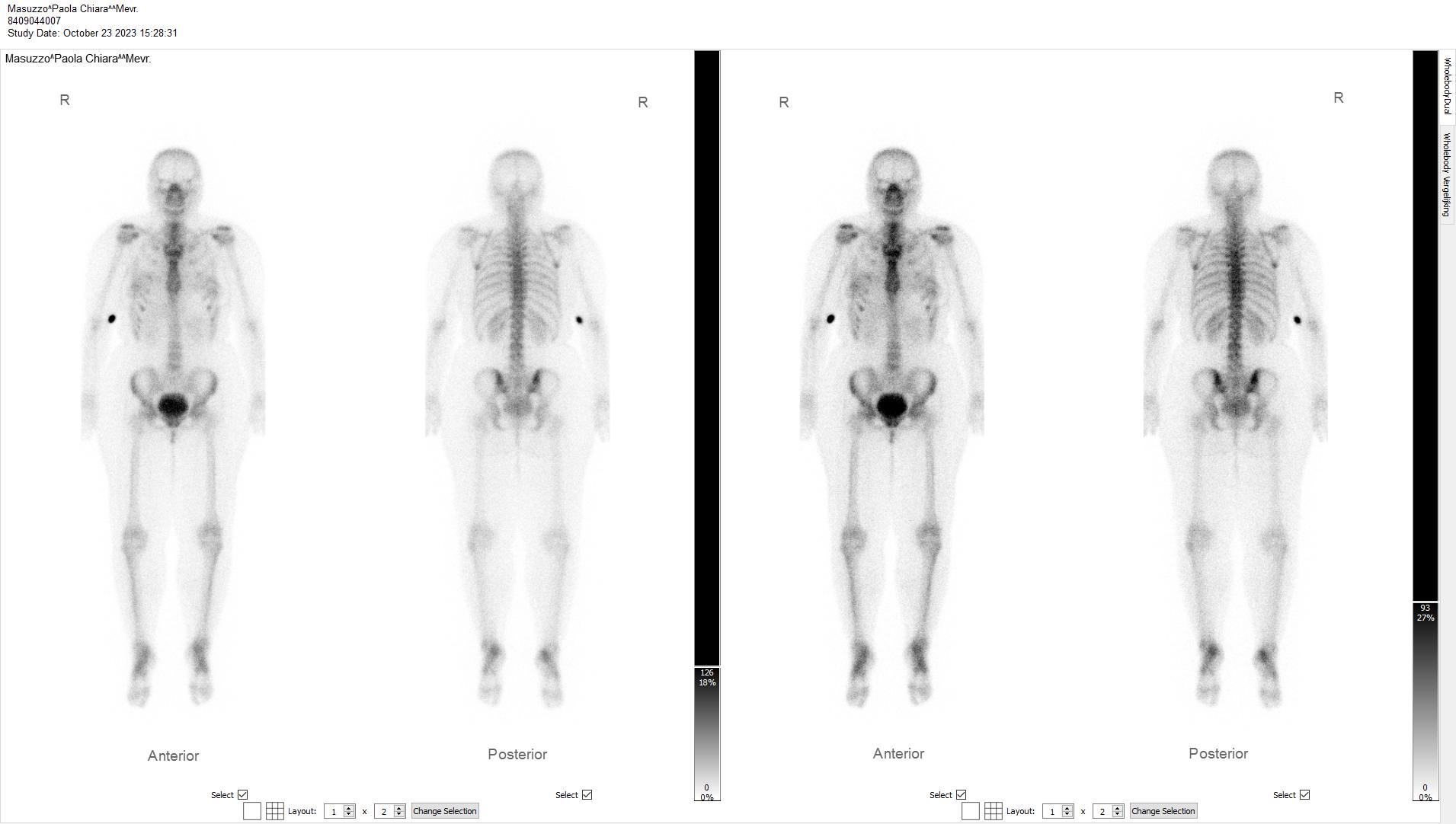 bone scan scintigraphy 