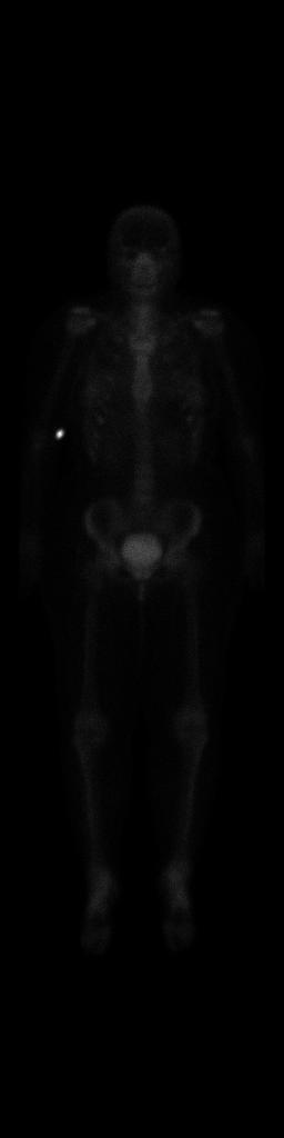 bone scan scintigraphy 