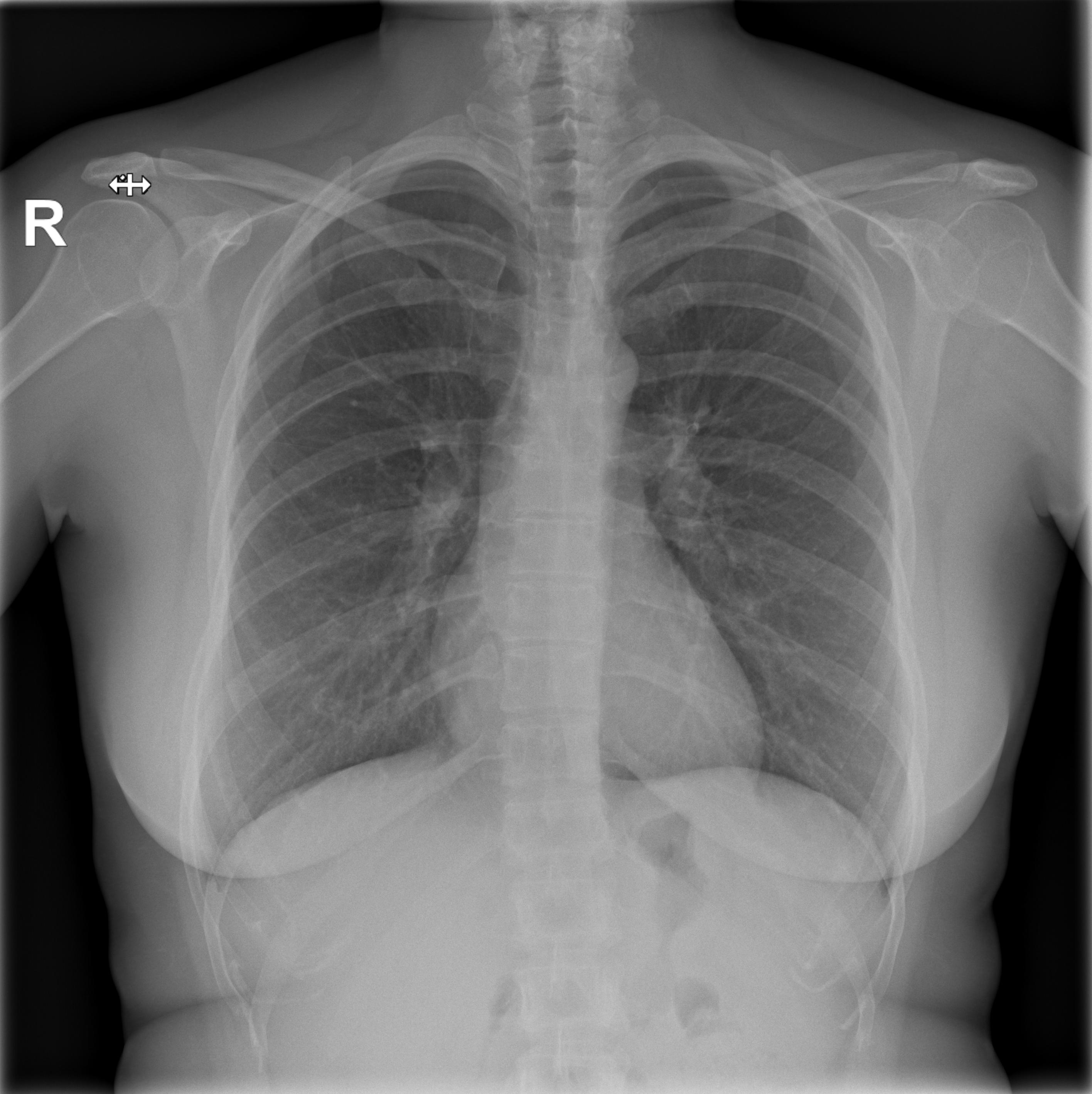 chest x-ray