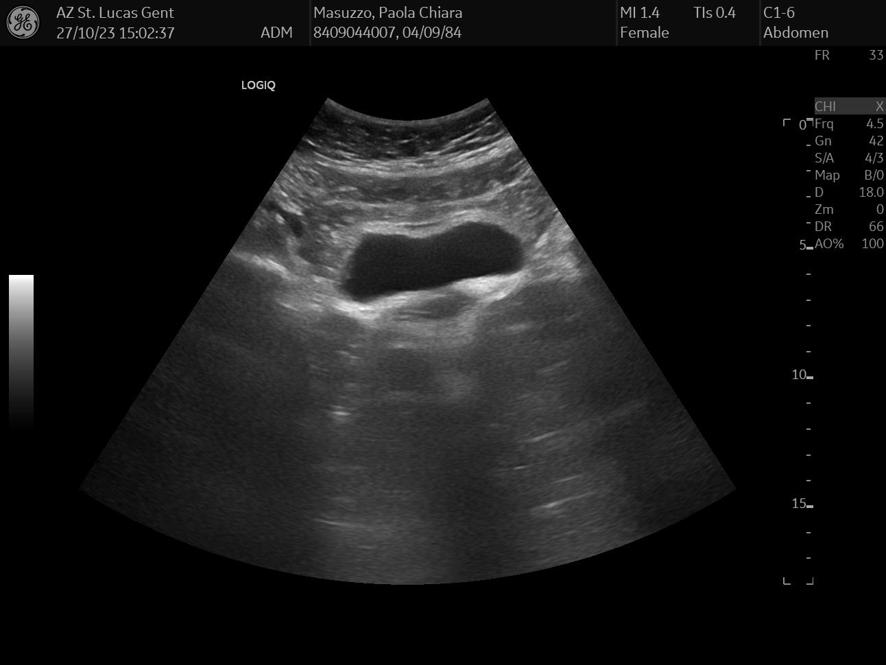 ultrasound liver, gallbladder, bile duct