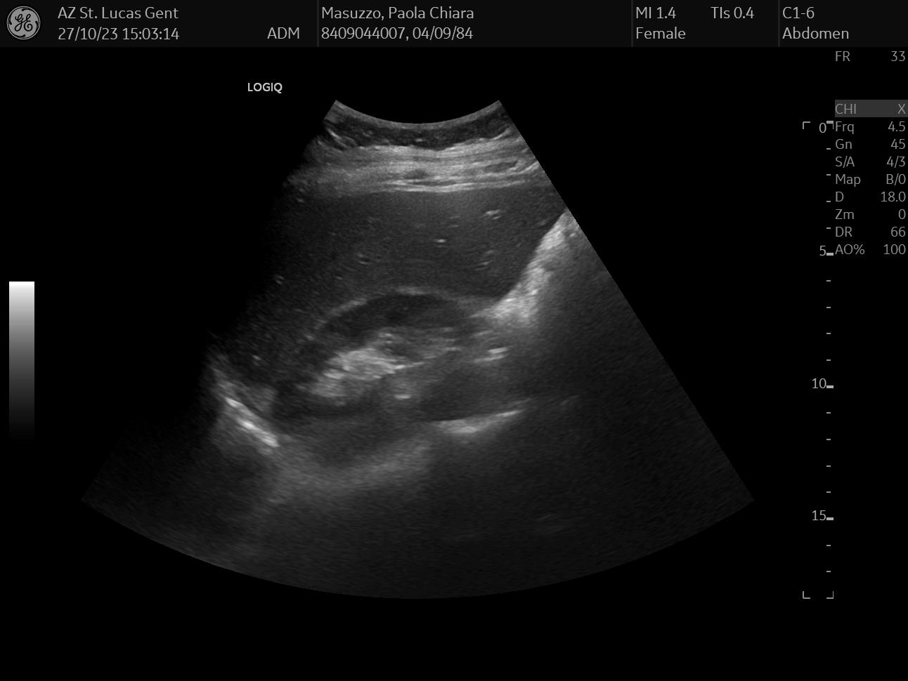 ultrasound liver, gallbladder, bile duct