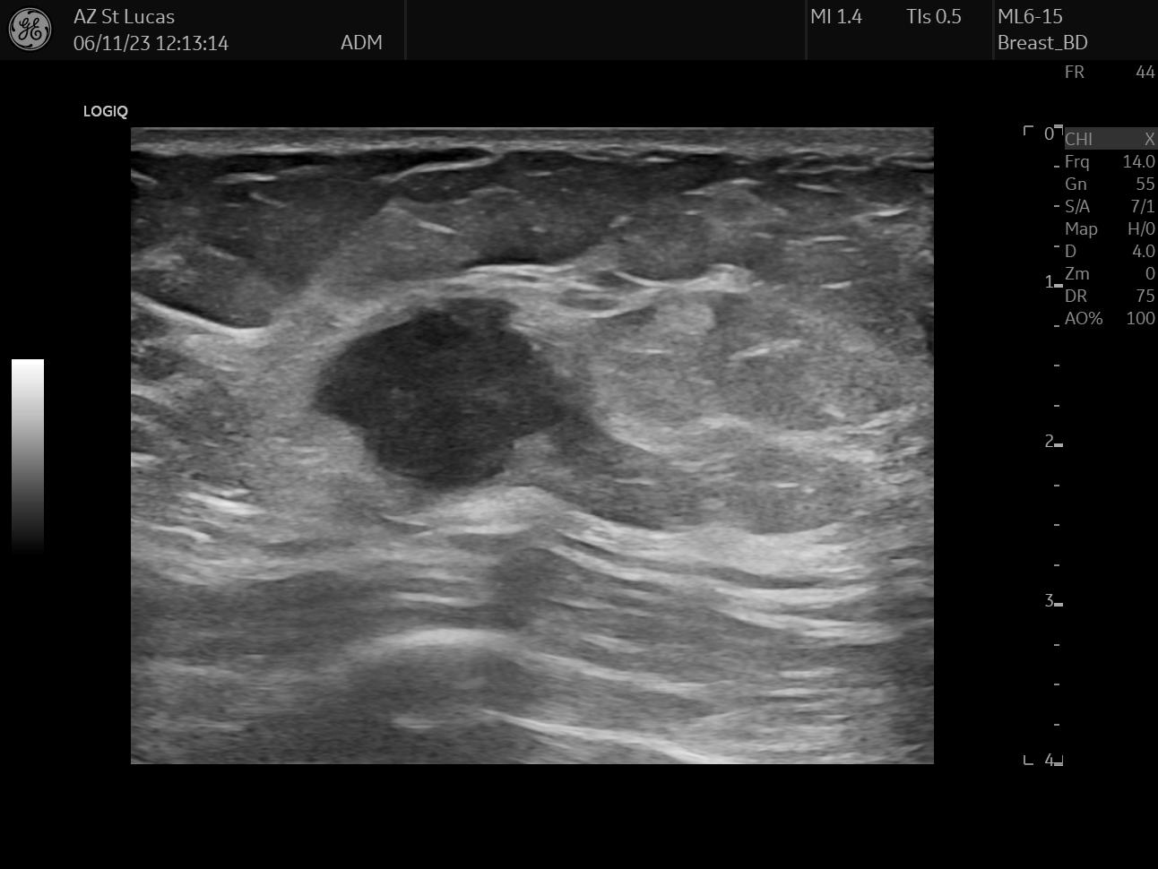 breast clip insertion