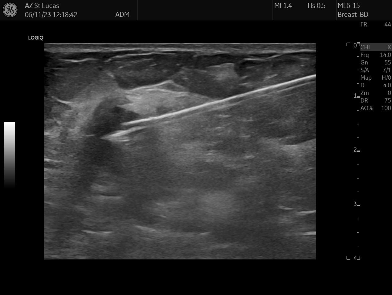 breast clip insertion