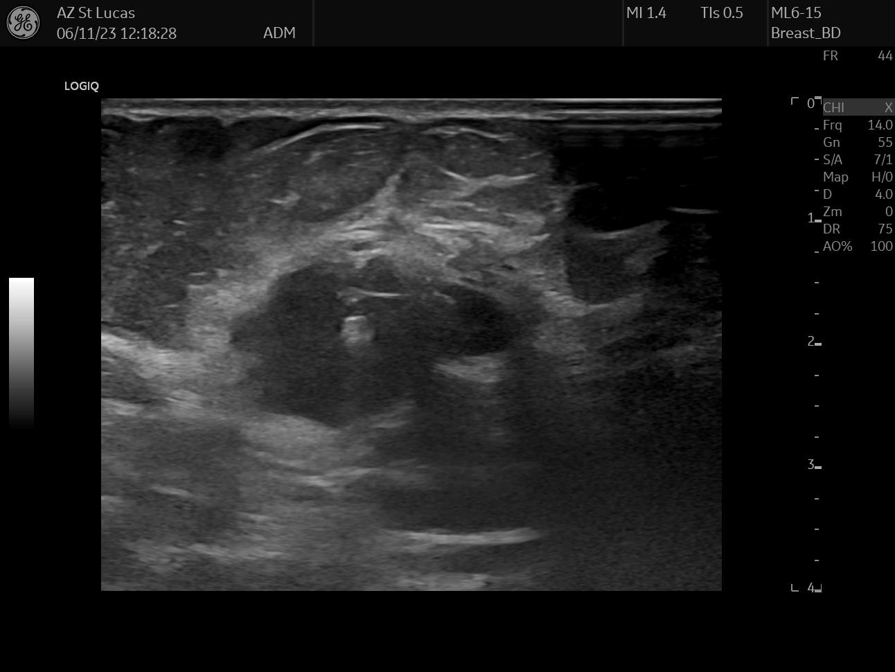 breast clip insertion