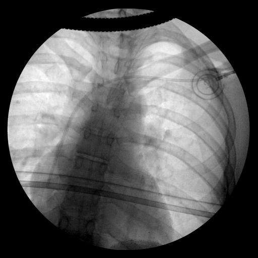 surgery to implant my port-a-cath