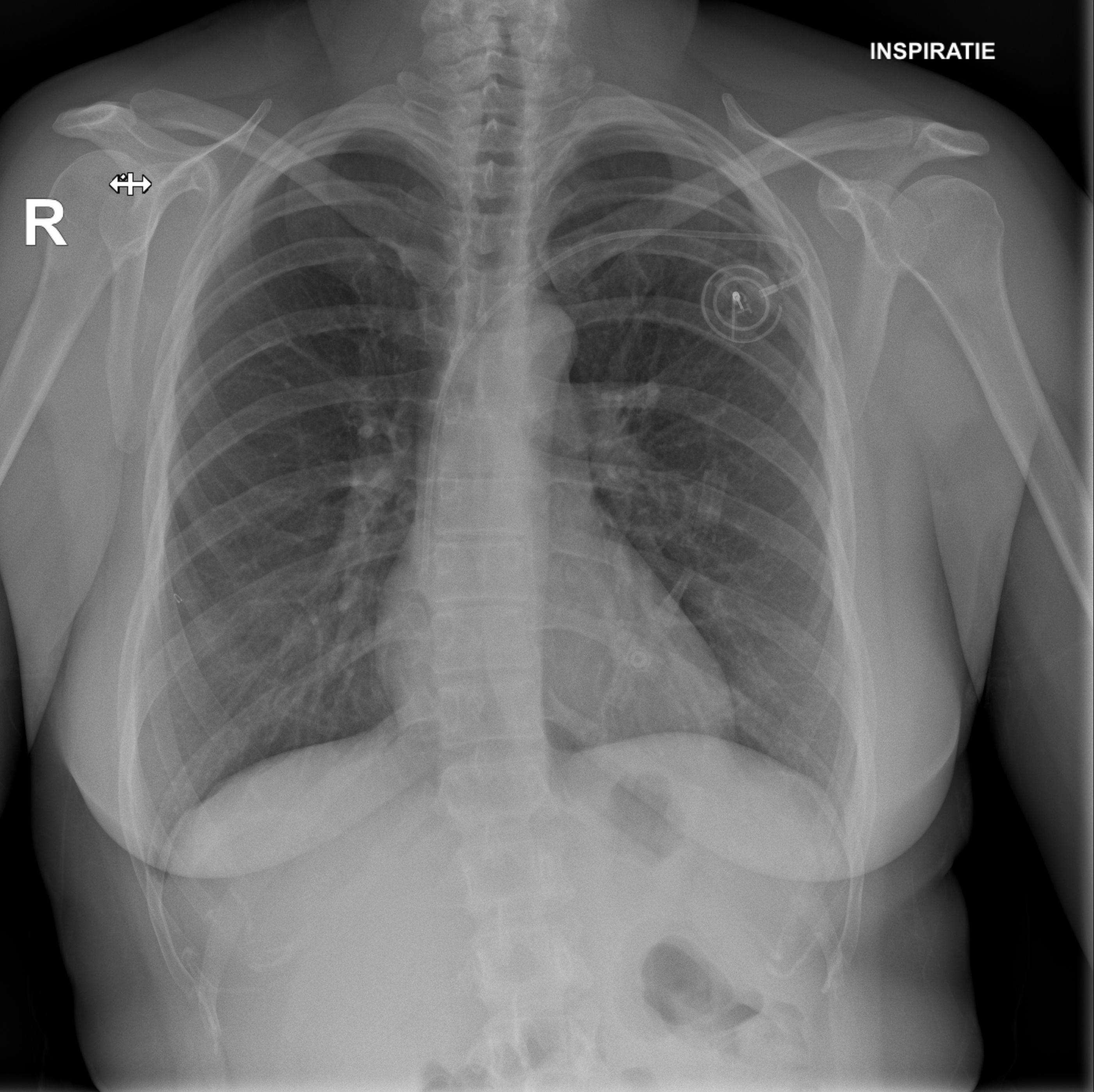 first chemotherapy session
