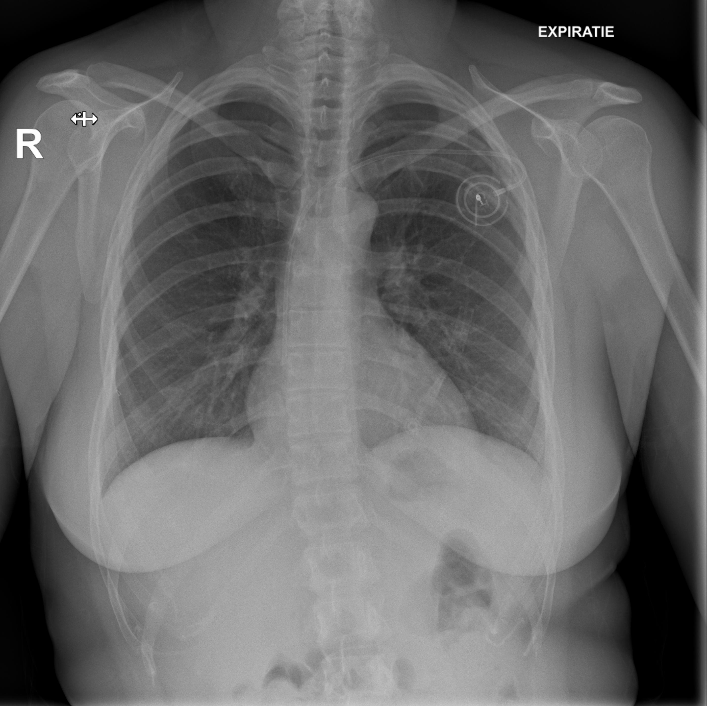 first chemotherapy session