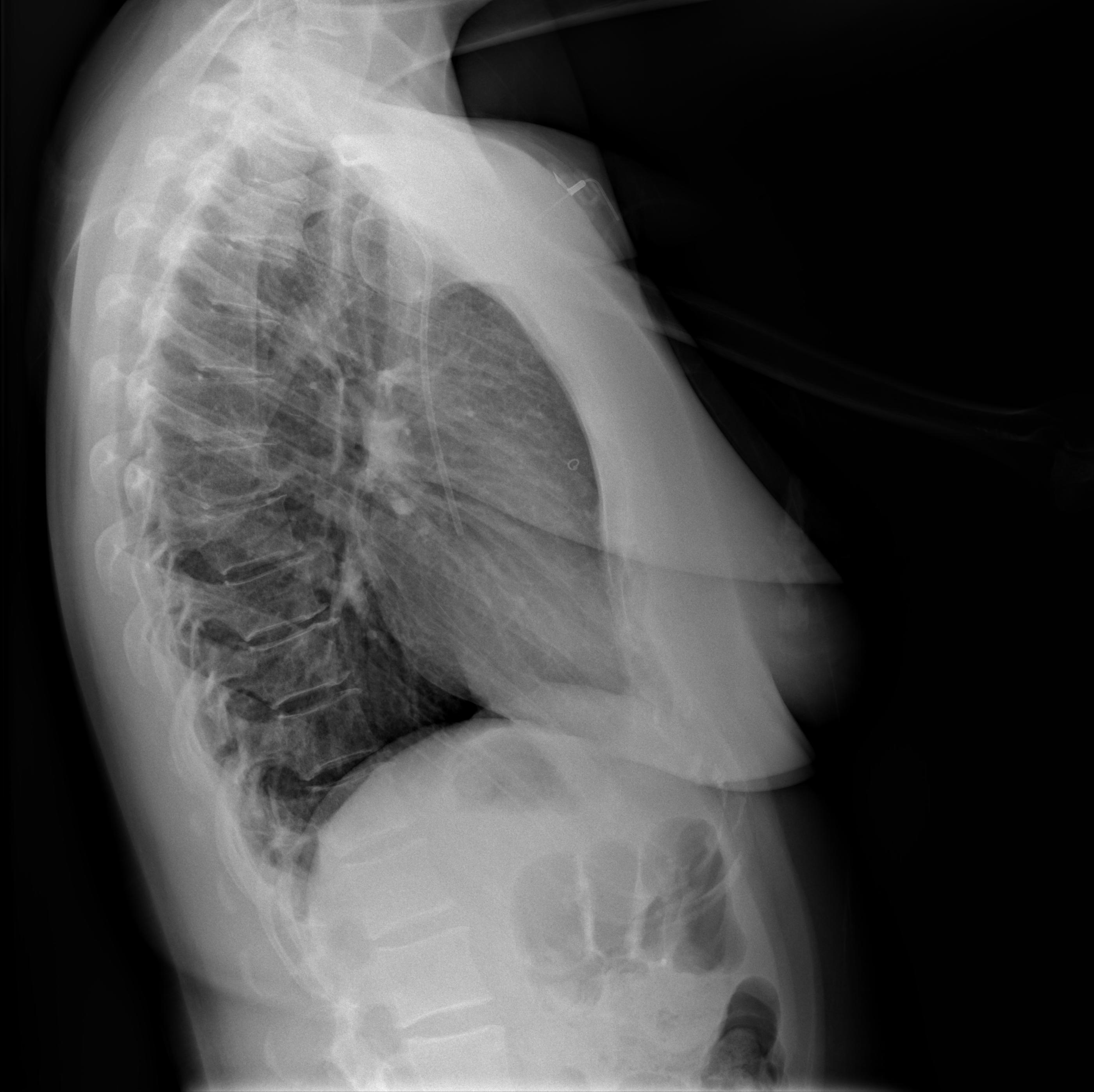 first chemotherapy session